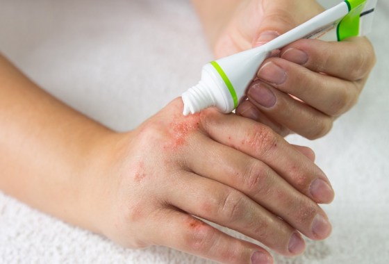 Best eczema product